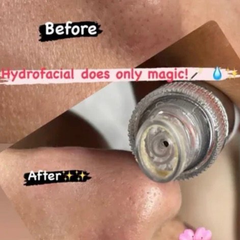 Korean Hydra Facial at Michelle's Skin Studio