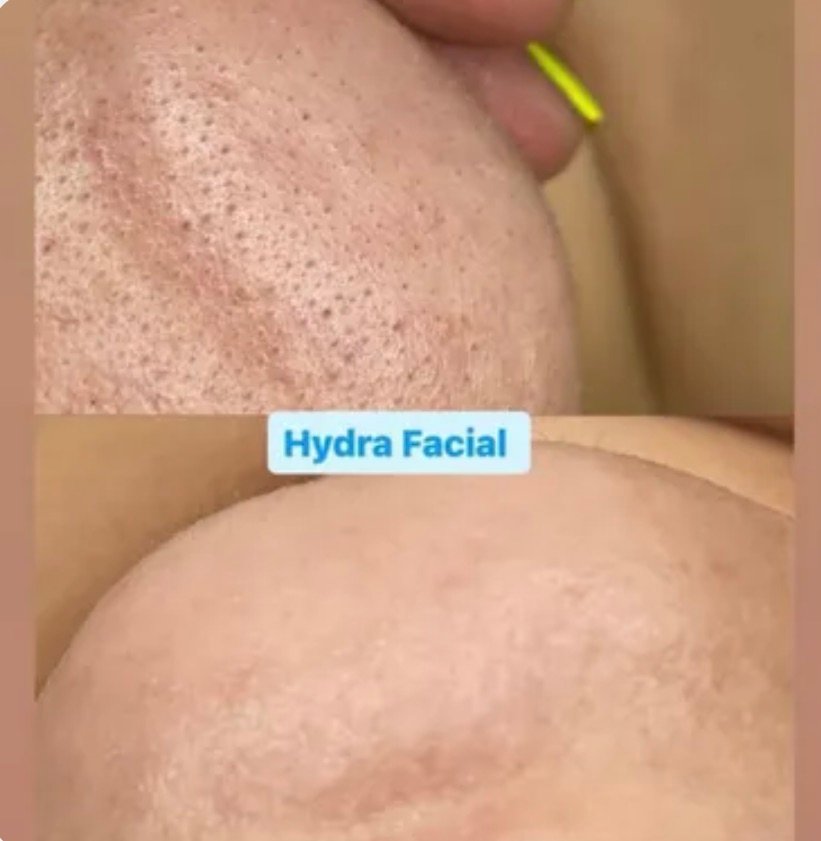 Teen Glow Facial at Michelle's Skin Studio